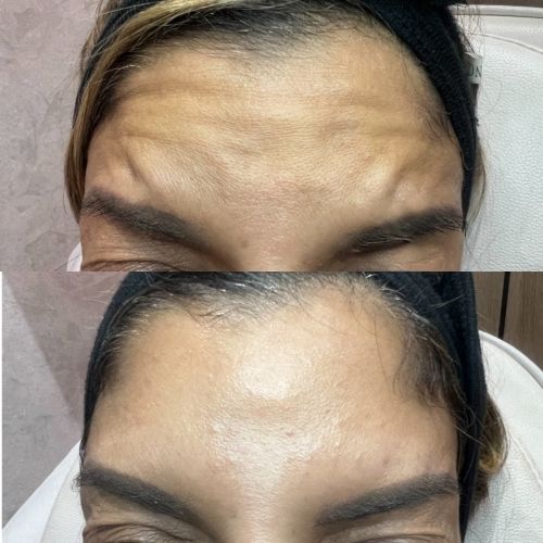 Botox