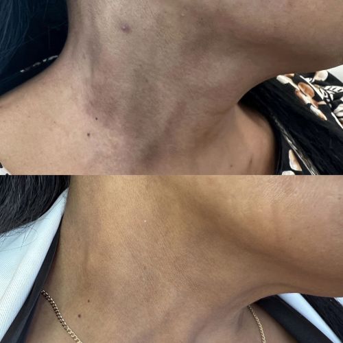 Malasma