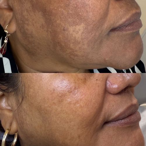 Melasma