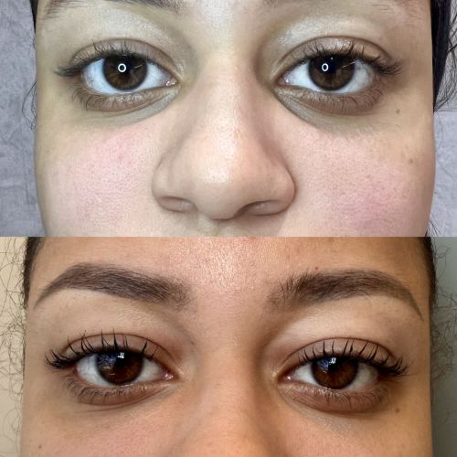Relleno de Ojeras